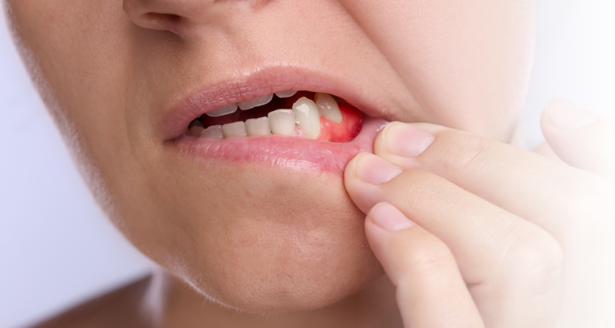 Gum Disease Prevention and Treatment: Expert Care from Your Dentist at Lawrence and Allen