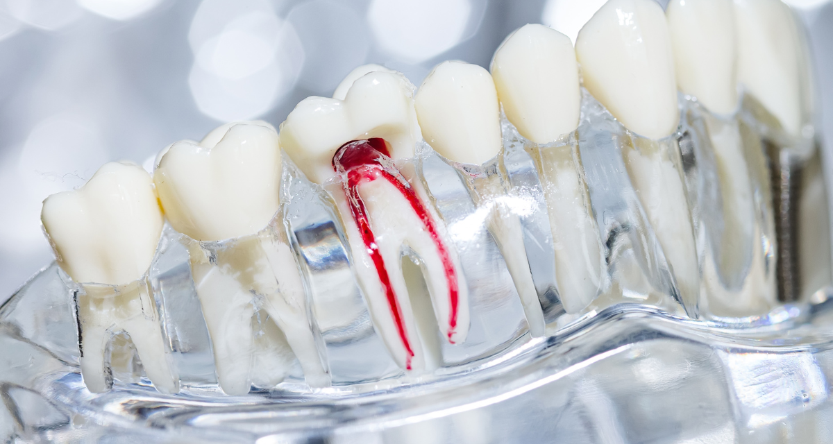Root Canals: What to Expect from Your North York Dentist