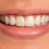 Smile showing a front tooth repaired with a natural-looking tooth-colored filling for a dental fillings article by Dentistry in Motion in North York.